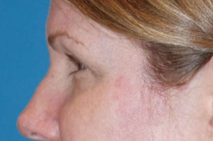 Eyelid Lift- Lower Before & After Patient #742