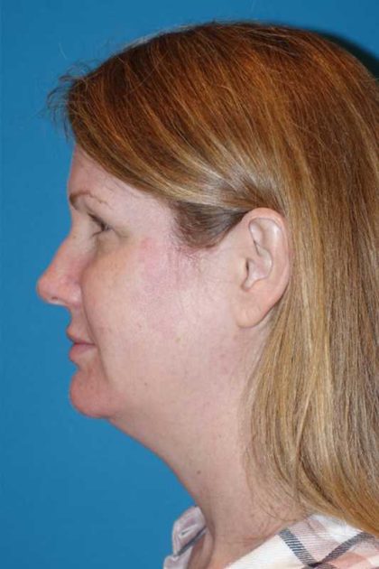 Morpheus8 Before & After Patient #693