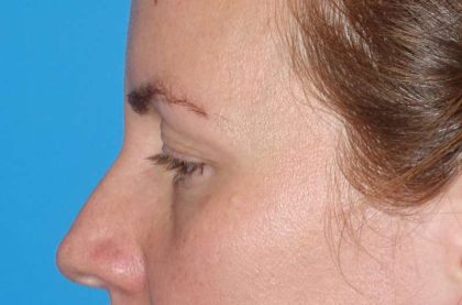 Eyelid Lift- Upper Before & After Patient #765
