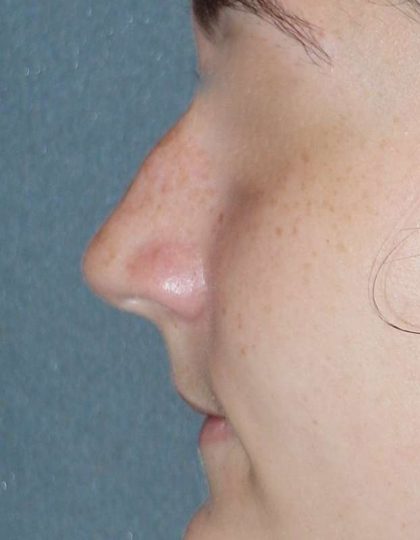 Rhinoplasty Before & After Patient #787