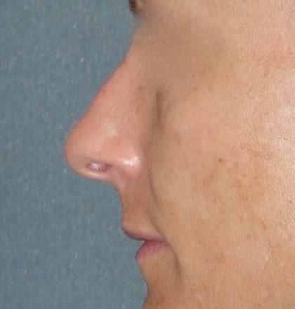 Rhinoplasty Before & After Patient #798