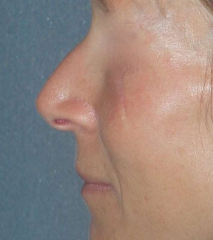 Rhinoplasty Before & After Patient #809