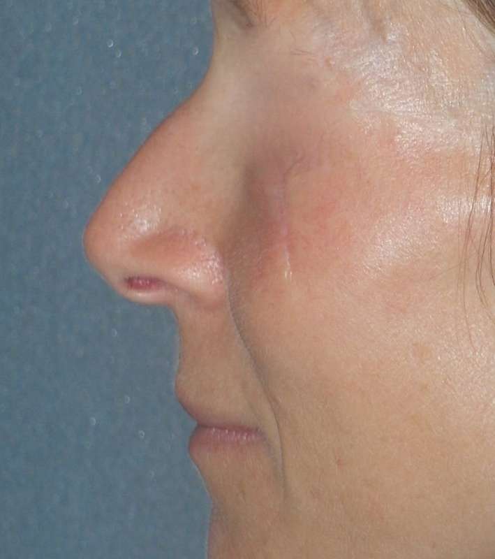 Rhinoplasty Before & After Patient #809