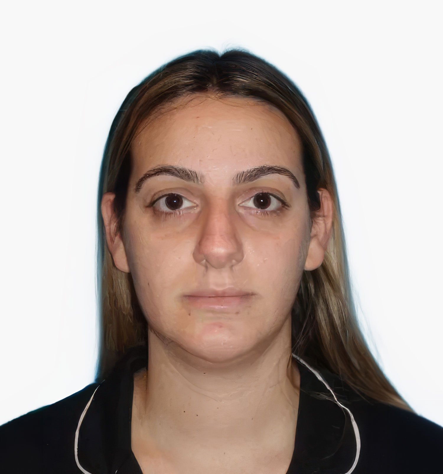 Facial rejuvenation patient result, before