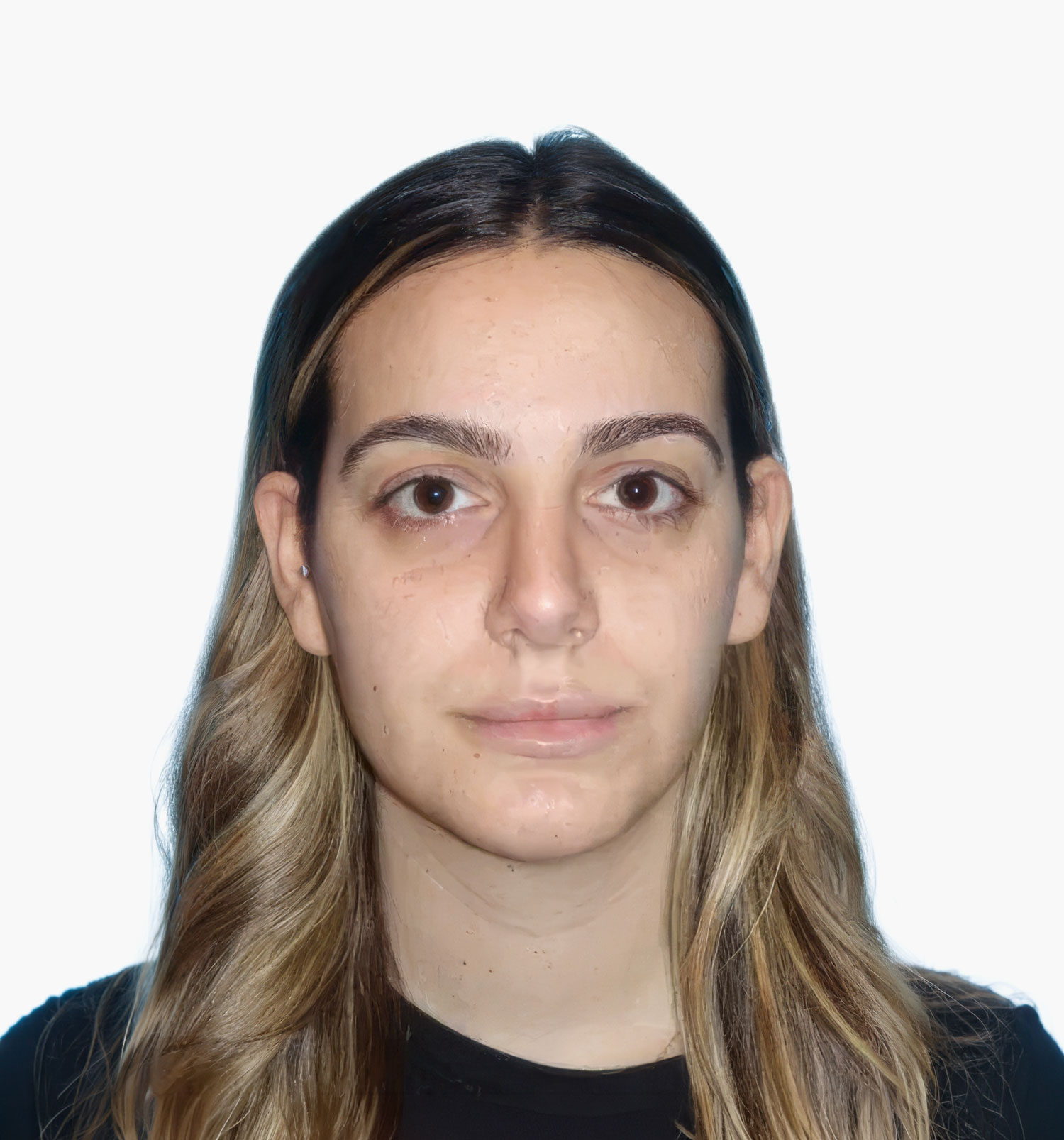 Facial rejuvenation patient result, after