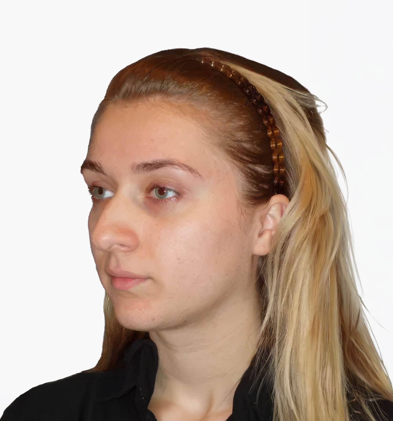 Facial rejuvenation patient result, before