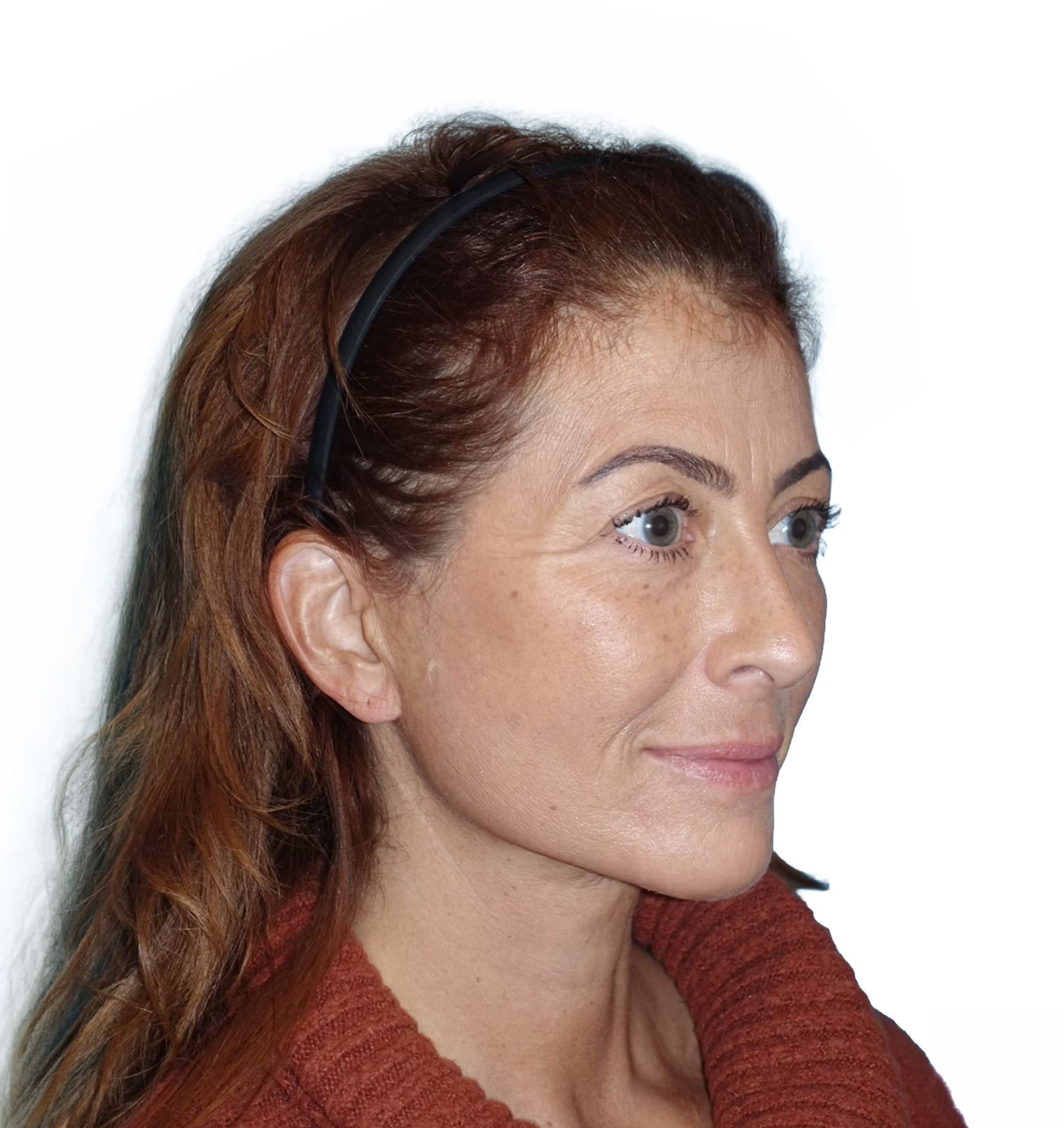 Facelift patient, three-quarter view, after